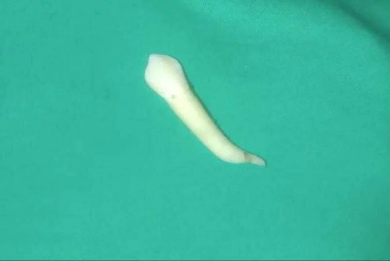 Record-breaking tooth pulled by dentist in India