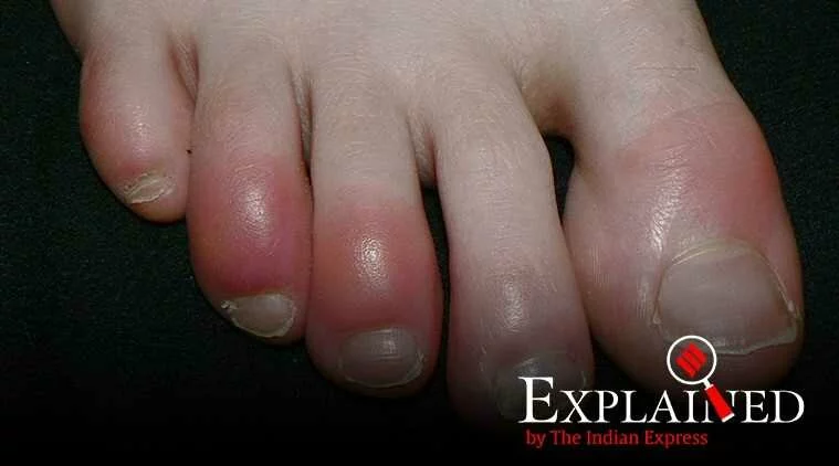 Explained: What is ‘covid toe’ condition that has left researchers puzzled?